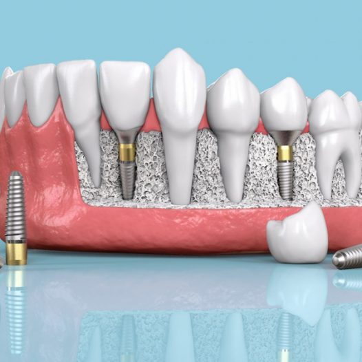 What Are Dental Implants? Eligibility, Benefits, and Care Tips