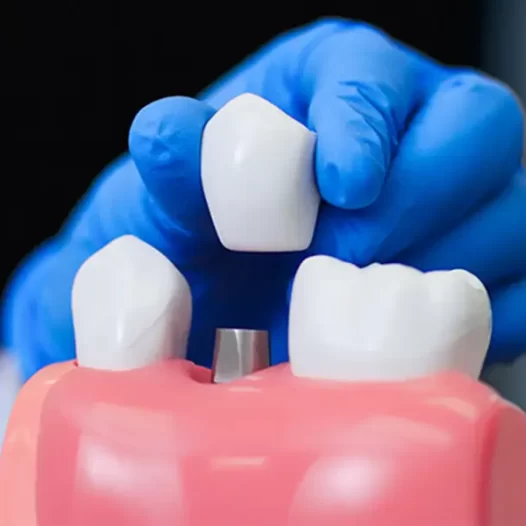 What Are Dental Implants? Eligibility, Benefits, and Care Tips
