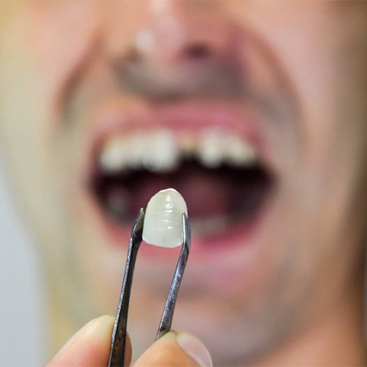 Unique Features Of Porcelain Veneers