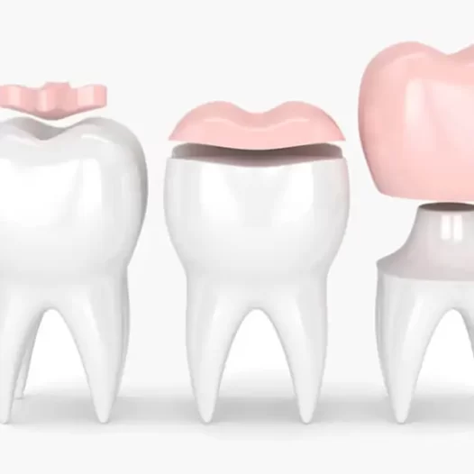 An Overview of Inlays and Onlays in Dentistry