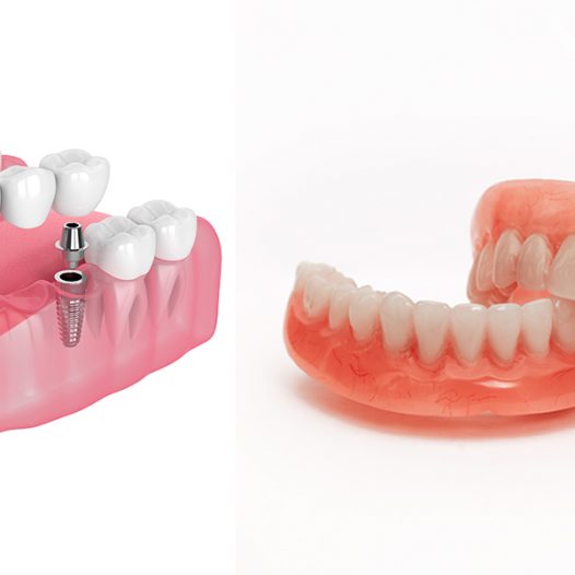 Removable Dental Bridge vs. Fixed Bridge