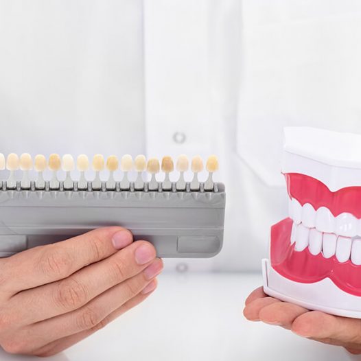 How To Choose The Right Porcelain Veneers For Your Smile?