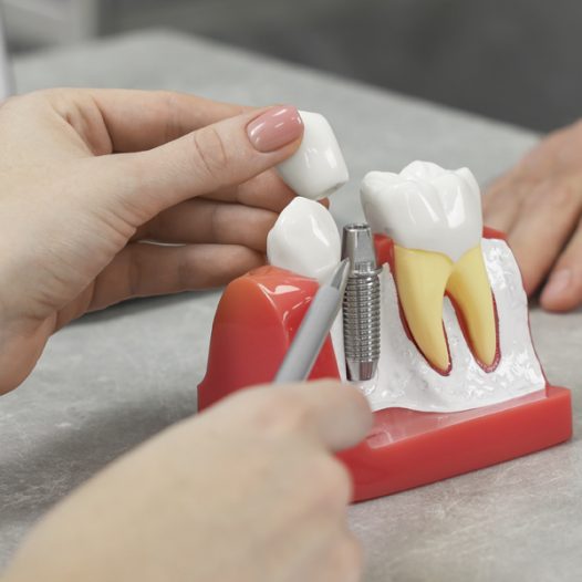 Dental Implants Vs. Bridges: Guide on Choosing the Right One