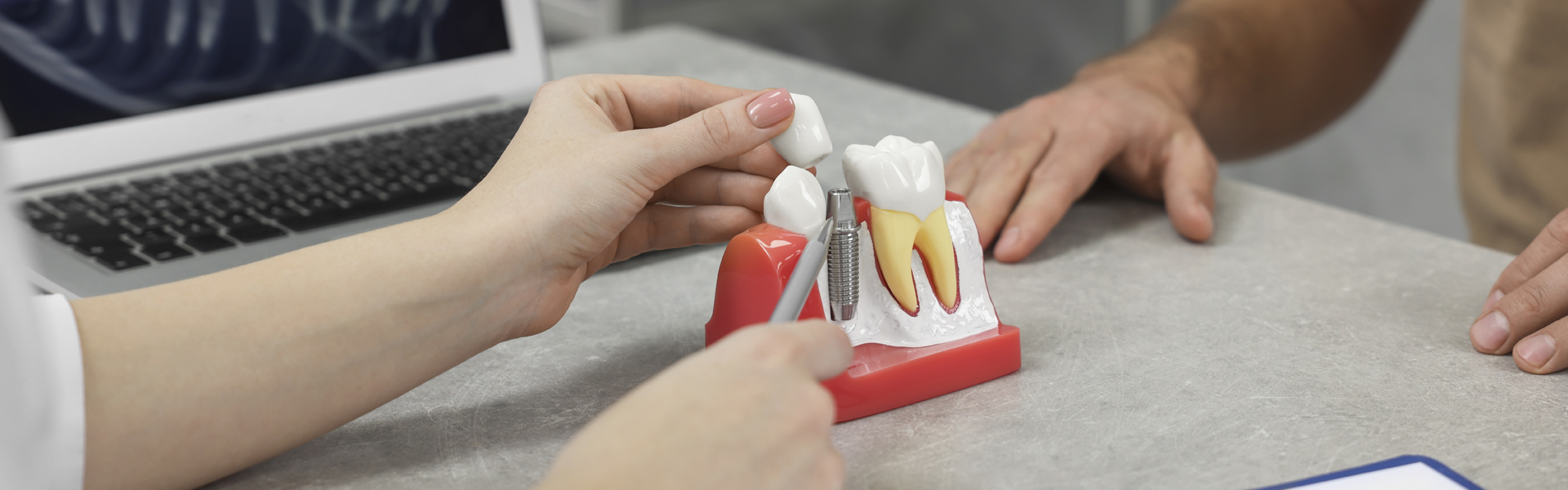 Dental Implants Vs. Bridges: Guide on Choosing the Right One