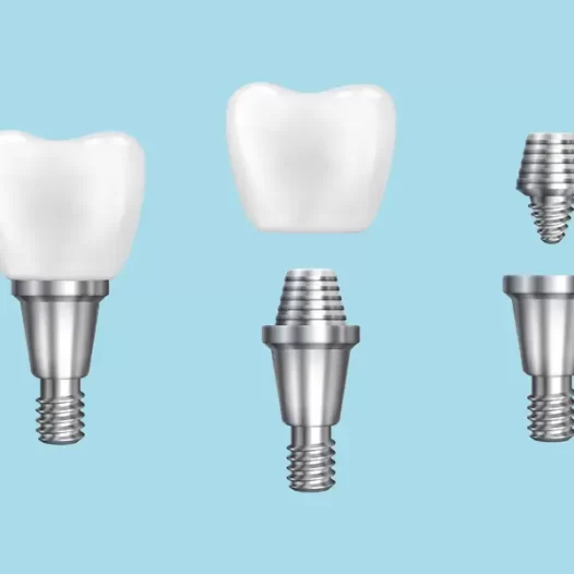 The Ultimate Dental Implants Guide: Everything You Must Know