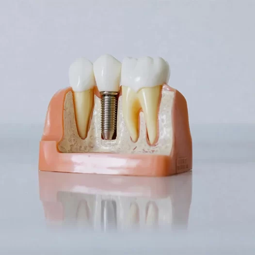 Want a Permanent Smile Solution? Learn About Dental Implants
