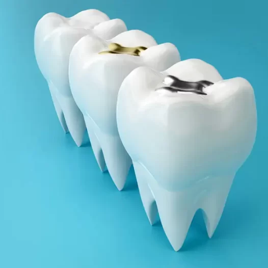 Dental Fillings for Front Teeth: A Simple Smile Repair